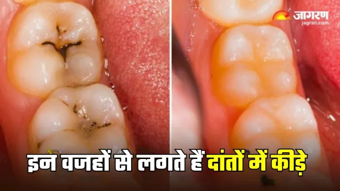 दांतों में क्यों लग जाते हैं कीड़े (Picture Credit- Freepik)