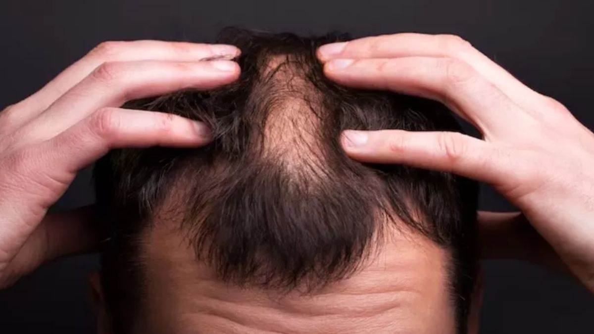 https://www.jagranimages.com/images/newimg/04072025/04_07_2025-baldness_23975417.jpg