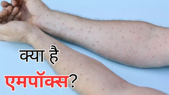 जानें क्या है एमपॉक्स और इसके लक्षण