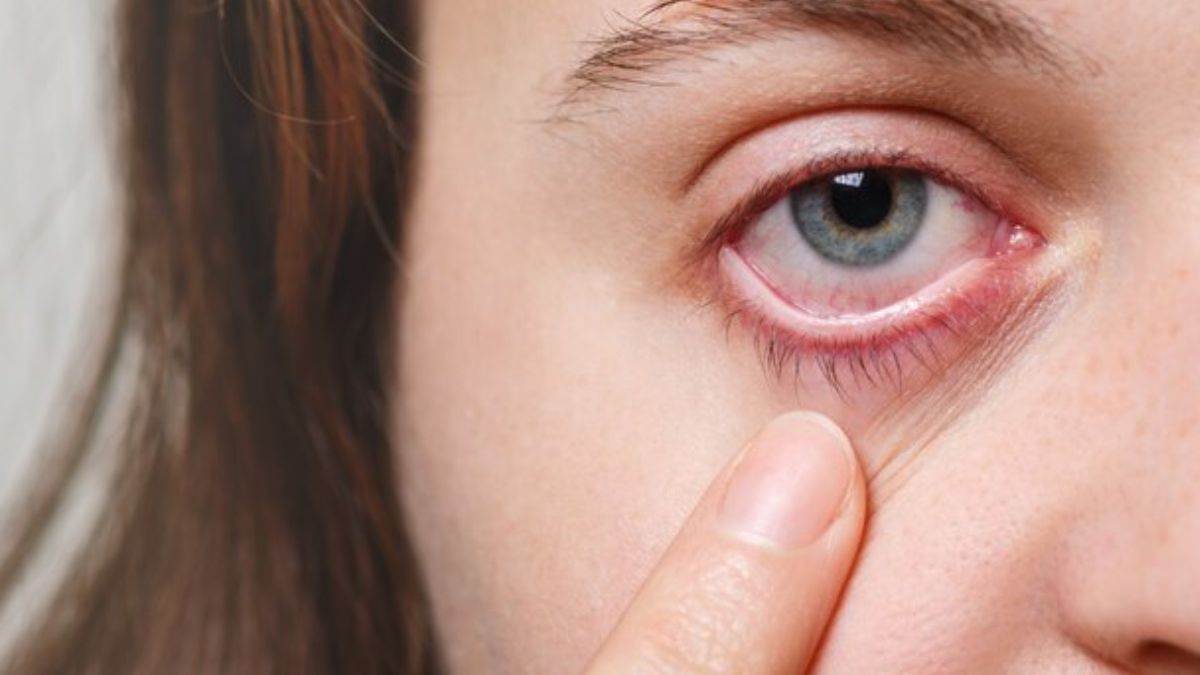 home remedies to prevent conjunctivitis or to get relief from pink eye