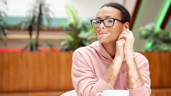 Vitiligo Causes: सफेद दाग होने के कारण, लक्षण और इलाज