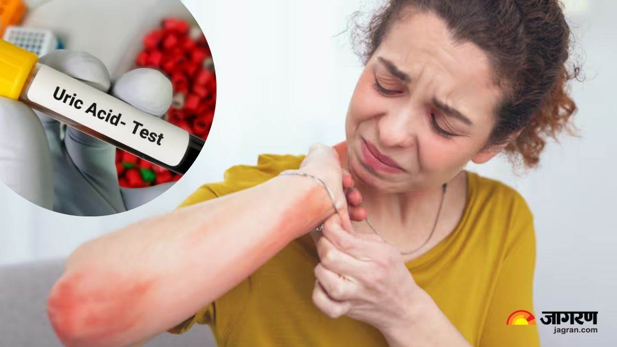 5 skin signs of high uric acid you shouldnt ignore