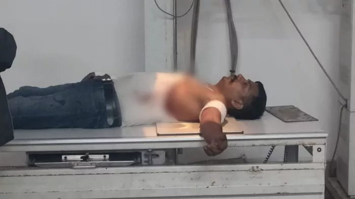 पुलिस टीम पर जानलेवा हमला, दो ASI समेत तीन घायल; बारीगोड़ा रेलवे फाटक के पास की घटना
