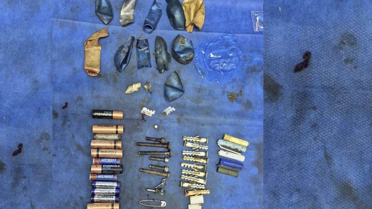 ncr tragic end teen dies after doctors remove 65 objects from stomach in delhi safdarjung hospital