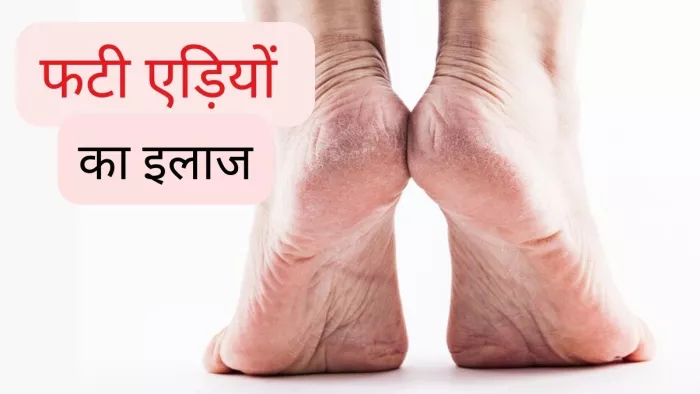 आई सर्दियां तो फटी एड़ियां करें परेशान,जाने इनसे जल्द छुटकारा पाने के उपाय
