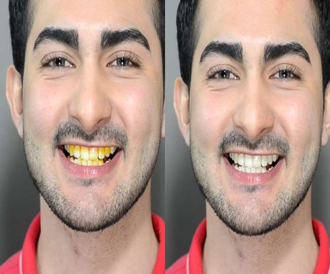 https://www.jagranimages.com/images/newimg/05012022/05_01_2022-teeth_22353742.jpg