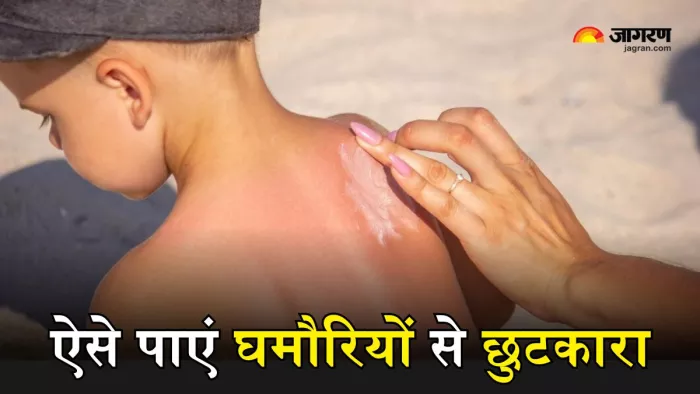 इन घरेलू नुस्खों से पाएं घमौरियों से आराम