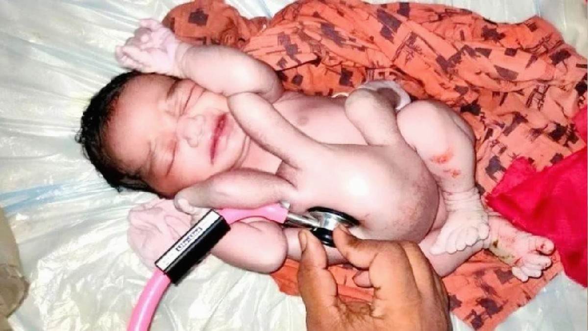 Hardoi News: हरदोई में चार हाथ और चार पैर वाले बच्चे का जन्म।