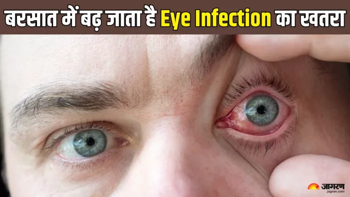 बरसात में बढ़ जाता है eye infections का खतरा (Picture Credit- Freepik)