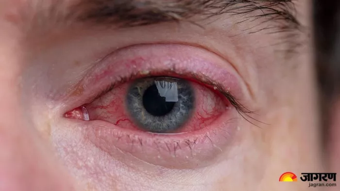 मानसून में Eye Infection बन सकता है मुसीबत, बचाव के लिए अपनाएं ये टिप्स (Image Source: X)
