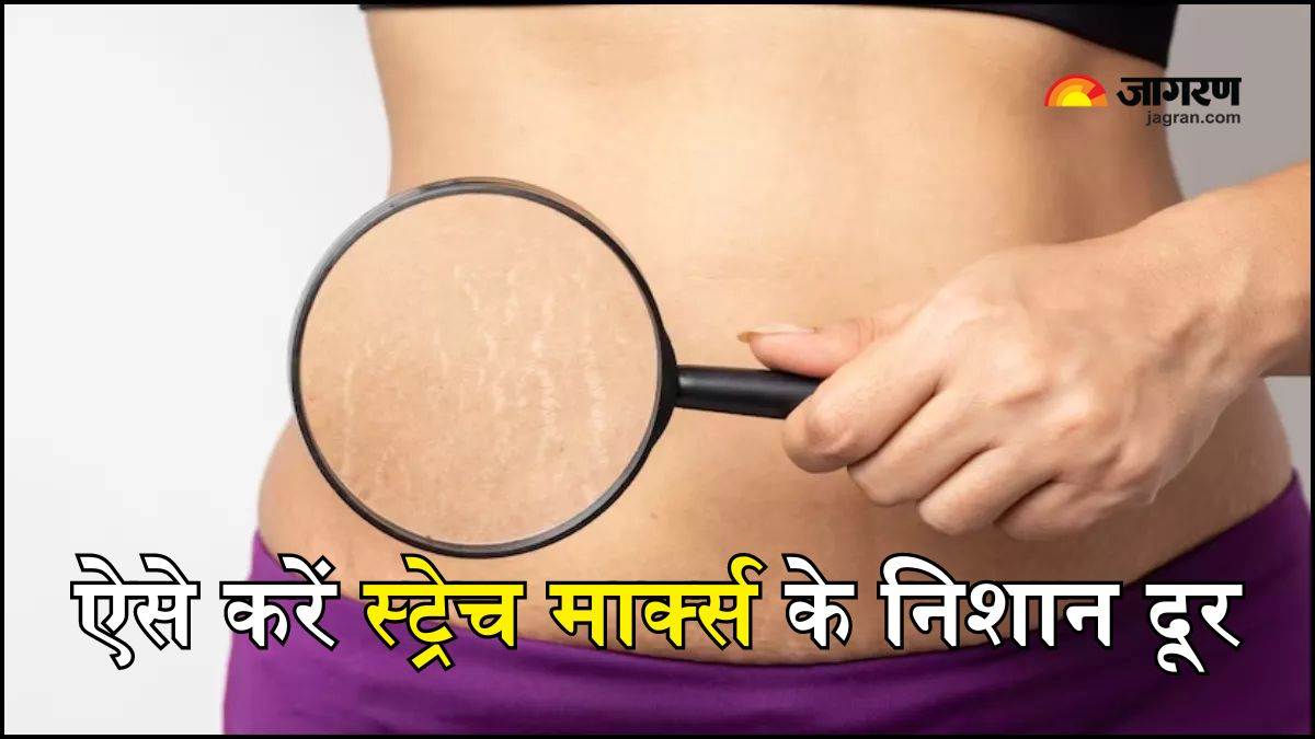 https://www.jagranimages.com/images/newimg/05072024/05_07_2024-remedies_for_stretch_marks_23752696.jpg