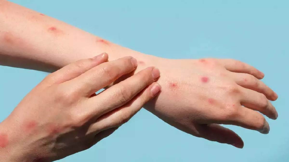 More than 26000 cases of monkeypox have been registered in 88 countries of the world including India - Monkeypox In World: मंकीपाक्स के बढ़ रहे मामले, भारत सहित दुनिया के 88 देशों