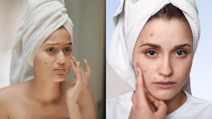 क्या हैं Blackheads और Whiteheads (Image Credit- Freepik)