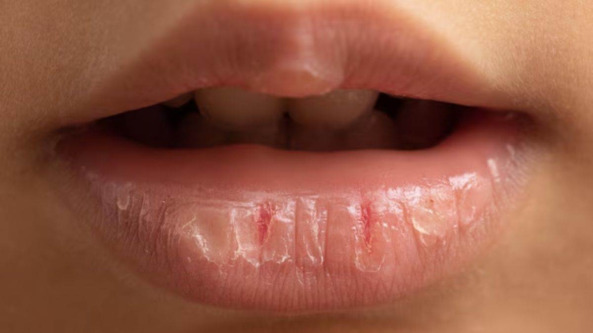https://www.jagranimages.com/images/newimg/05092025/05_09_2025-dry_lips_24036938.jpg