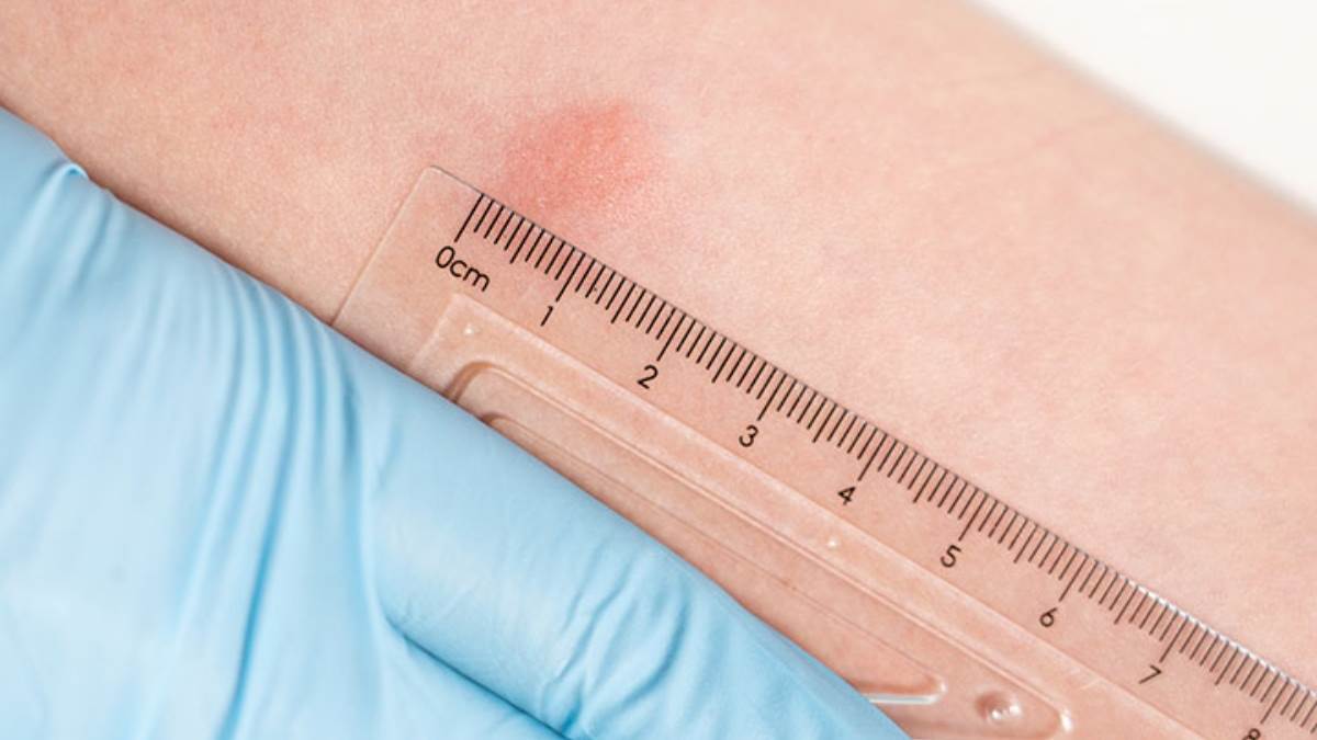 icmr approves indigenous tb testing kit for faster affordable detection