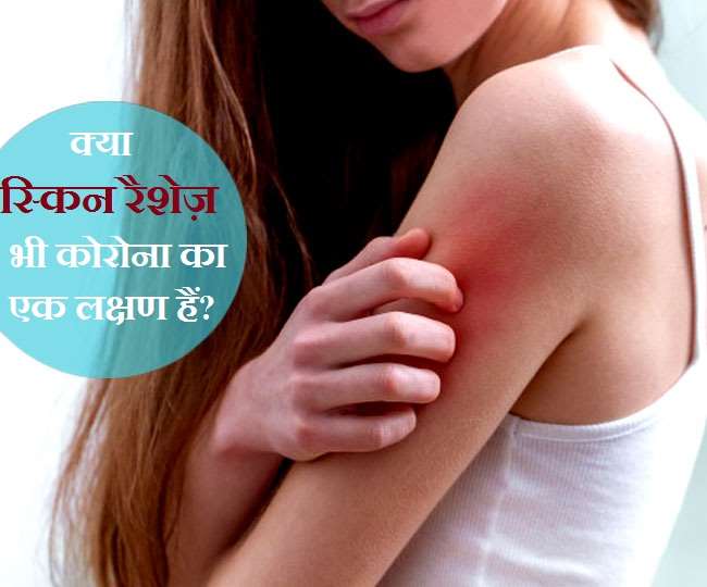 त्वचा पर चकत्ते भी हो सकता है कोरोना वायरस का लक्षण, ऐसे पहचानें