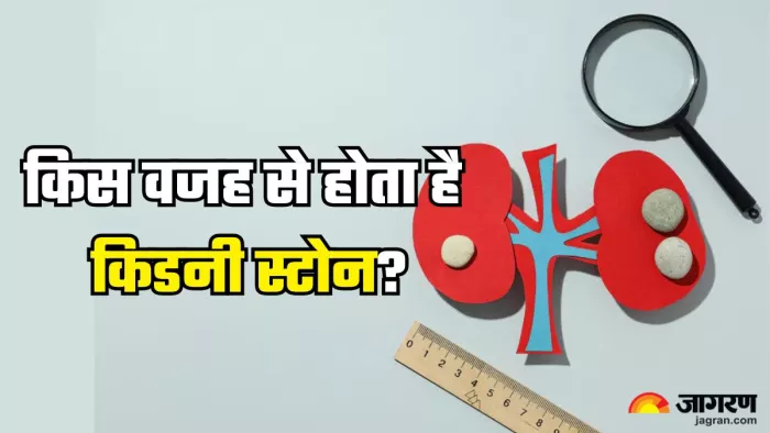क्यों होते है किडनी स्टोन और कैसे करें बचाव (Picture Credit- Freepik)