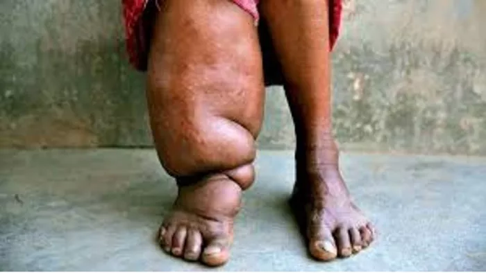 10 से फाइलेरिया उन्मूलन कार्यक्रम, 24 लाख को खिलाई जाएगी दवा।