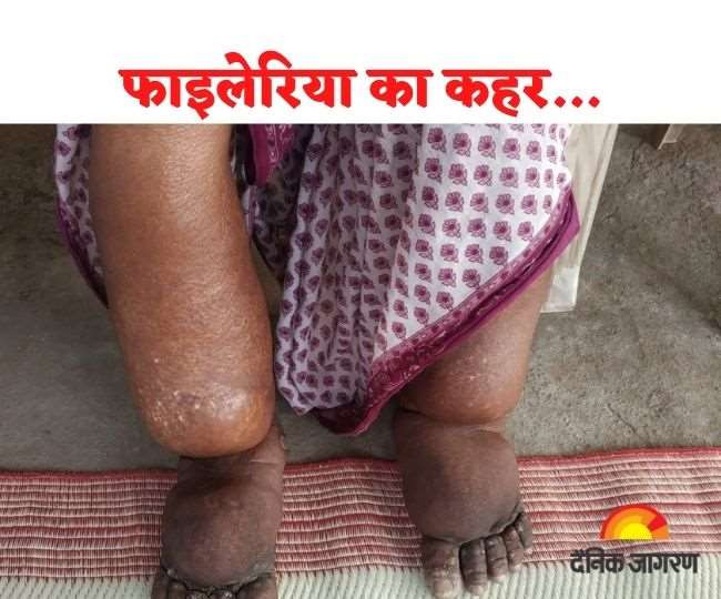 Jharkhand Health News: झारखंड सरकार सोमवार से फाइलेरिया उन्मूलन अभियान चलाने जा रही है।
