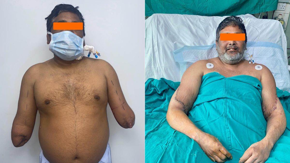 ncr delhi sir ganga ram hospital doctor done hand transplant to train accident victim raj kumar