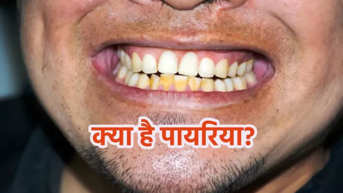 क्या है पायरिया की समस्या और किन विटामिन्स से होती है यह प्रॉब्लम