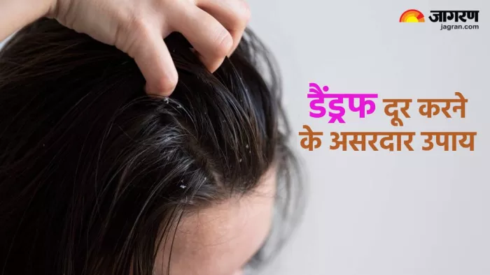 डैंड्रफ दूर करने के आयुर्वेदिक उपाय (Pic credit- freepik)