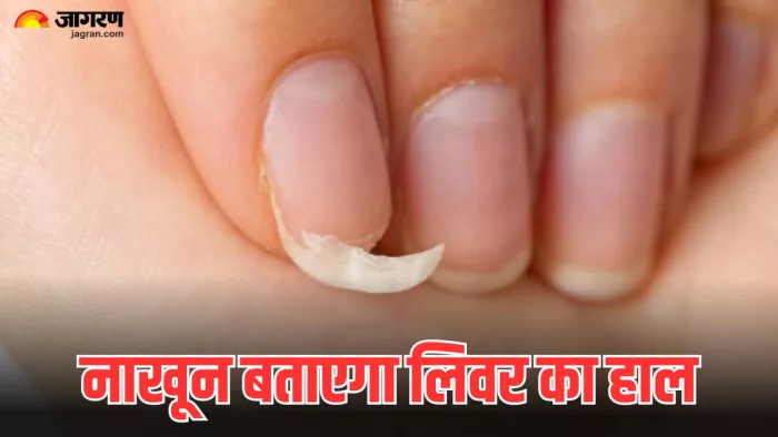 नाखूनों में नजर आते हैं लिवर से जुड़ी बीमारी के ये संकेत। (Image Credit- Freepik)