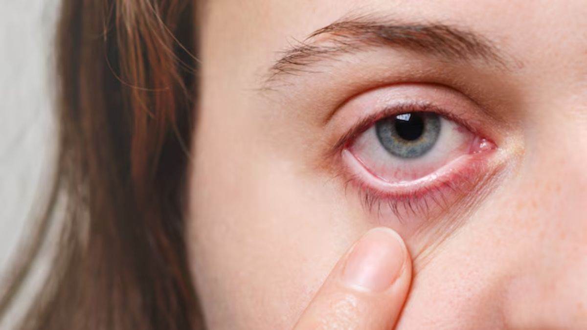 https://www.jagranimages.com/images/newimg/06072025/06_07_2025-dry_eyes_23976678.jpg