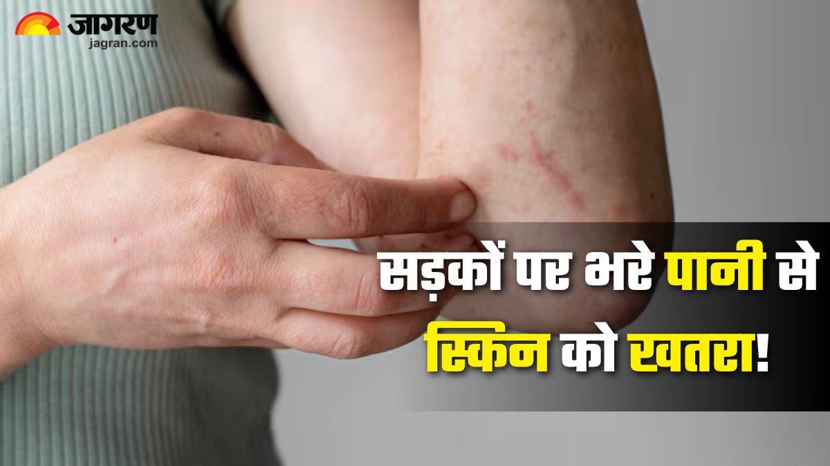 https://www.jagranimages.com/images/newimg/06082025/06_08_2025-fungal_infection_24005330.jpg