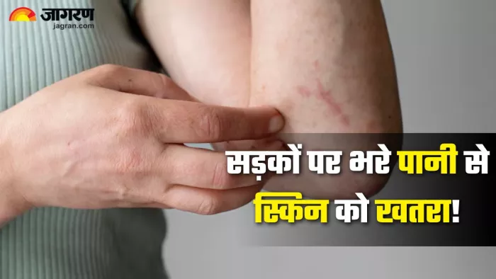 बरसात में स्किन इन्फेक्शन से कैसे बचें जानें कारण और बचाव के तरीके (Picture Credit- Freepik)