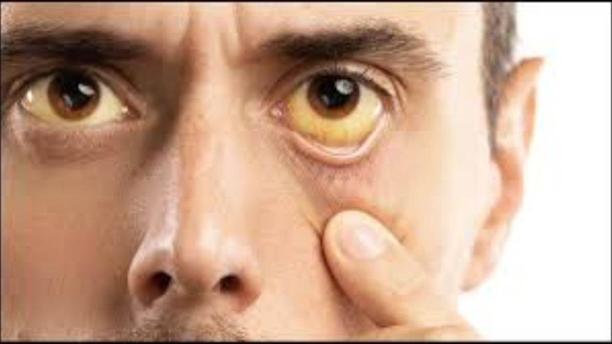 if you want to save your life from jaundice then keep these things in mind be careful as soon as you see these symptoms