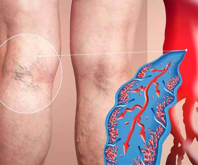 health tips if you see blood clots in your leg then understand that it is the effect of deep vein thrombosis