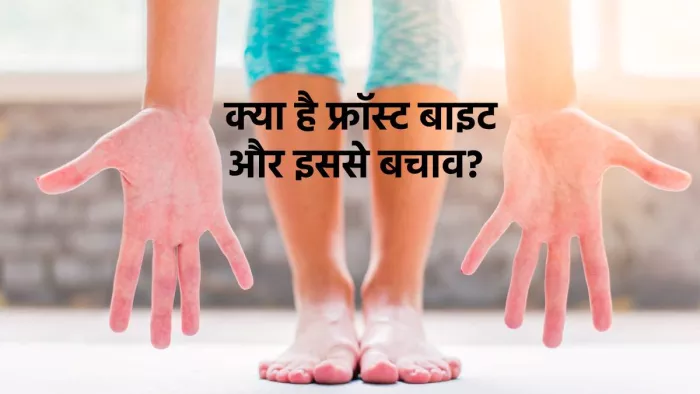 Frostbite Cure Tips: क्या है फ्रॉस्ट बाइट और इससे बचाव के उपाय