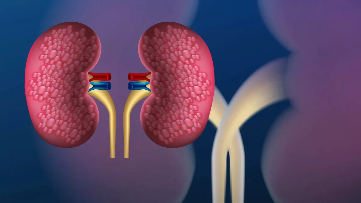 Kidney Transplant Precautions किडनी ट्रांसप्लांट के बाद मरीजों को इन