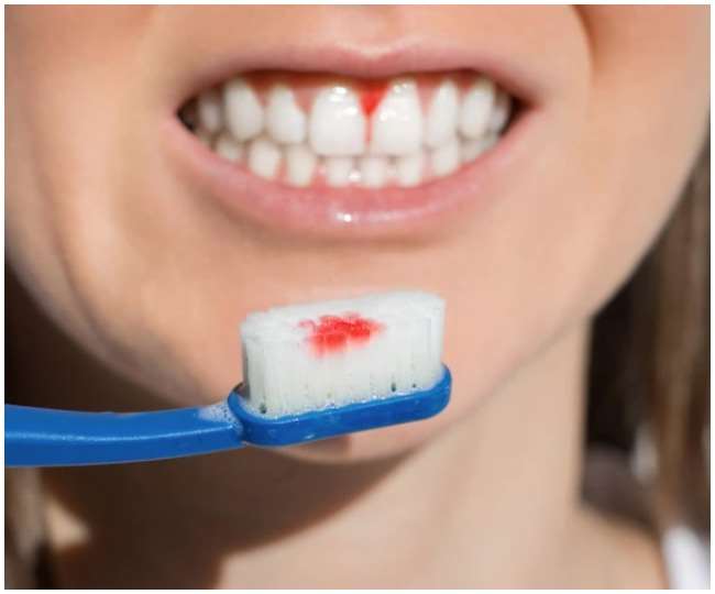 try these 8 home remedies to cure bleeding gums