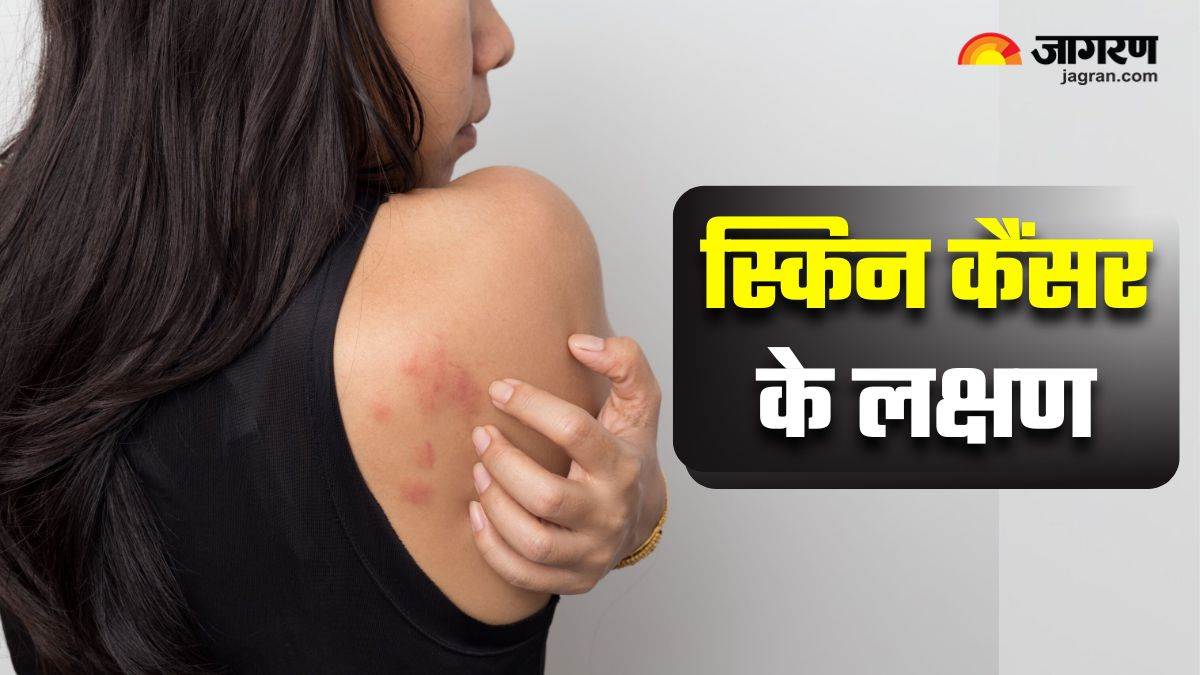 https://www.jagranimages.com/images/newimg/07042025/07_04_2025-early_signs_of_skin_cancer_23913658.jpg