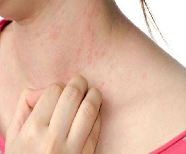कोरोना के मरीजों दाद, बाल झड़ना और नाखून टूटने जैसी समस्याएं