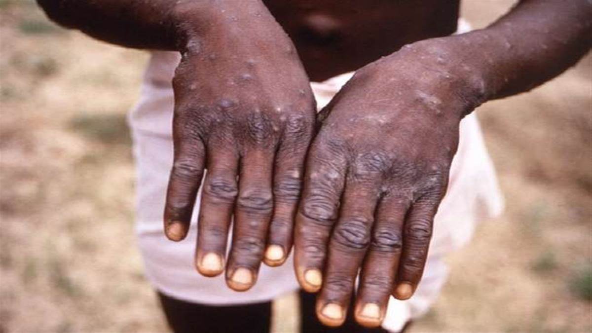 मंकीपाक्स के संदिग्ध मरीज का सैंपल लेने के बाद राहत की खबर सामने आई है