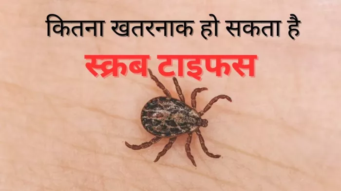 Scrub Typhus: जानें क्या है 'स्क्रब टाइफस' और कैसे होते हैं इसके लक्षण