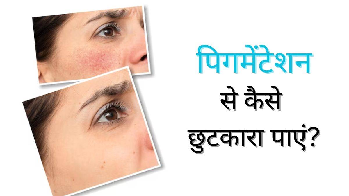 https://www.jagranimages.com/images/newimg/07102023/07_10_2023-pigmentation-remedies_23548129.jpg