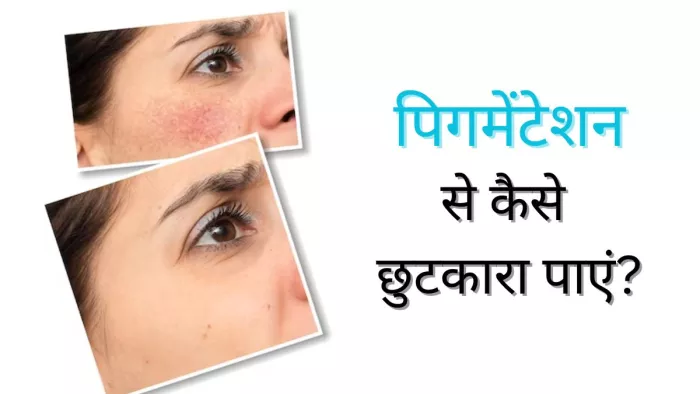 Pigmentation Home Remedies: स्किन पिगमेंटेशन की समस्या का ये है इलाज