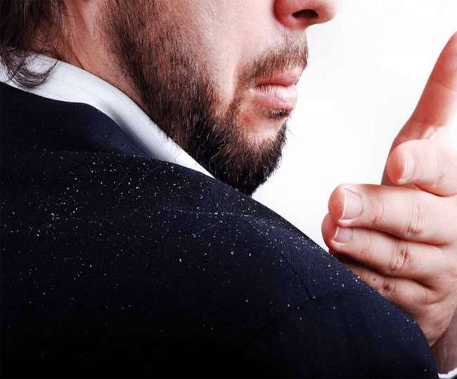 health tips if you want to remove dandruff then do this yogasana daily you will get rid of it quickly
