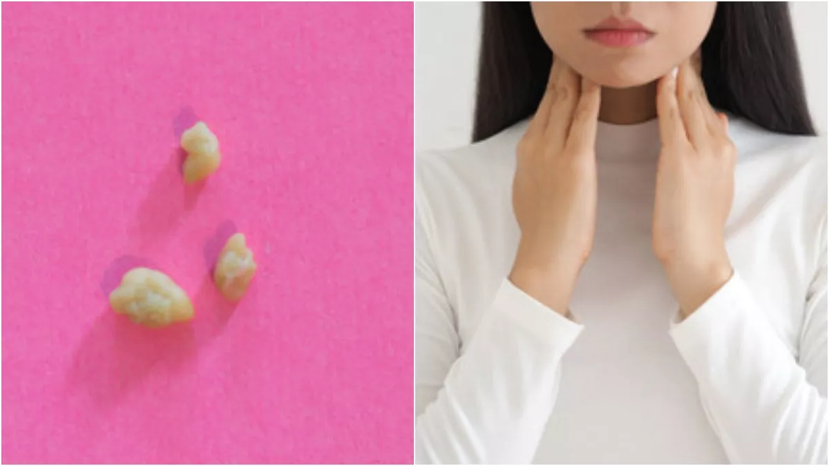 Tonsil Stones: गले में हो रही है दिक्कत तो ना करें नजर अंदाज, जानें टॉन्सिल स्टोन के लक्षण