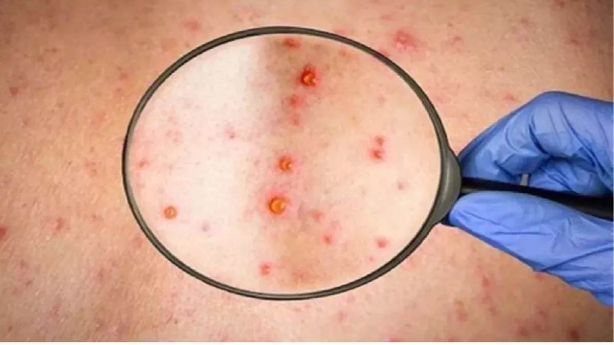 https://www.jagranimages.com/images/newimg/08042024/08_04_2024-11_06_2023-chickenpox_23438191_1_23692019.jpg