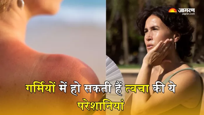 गर्मियों में बढ़ जाता है इन Skin Problems का खतरा (Picture Courtesy: Freepik)