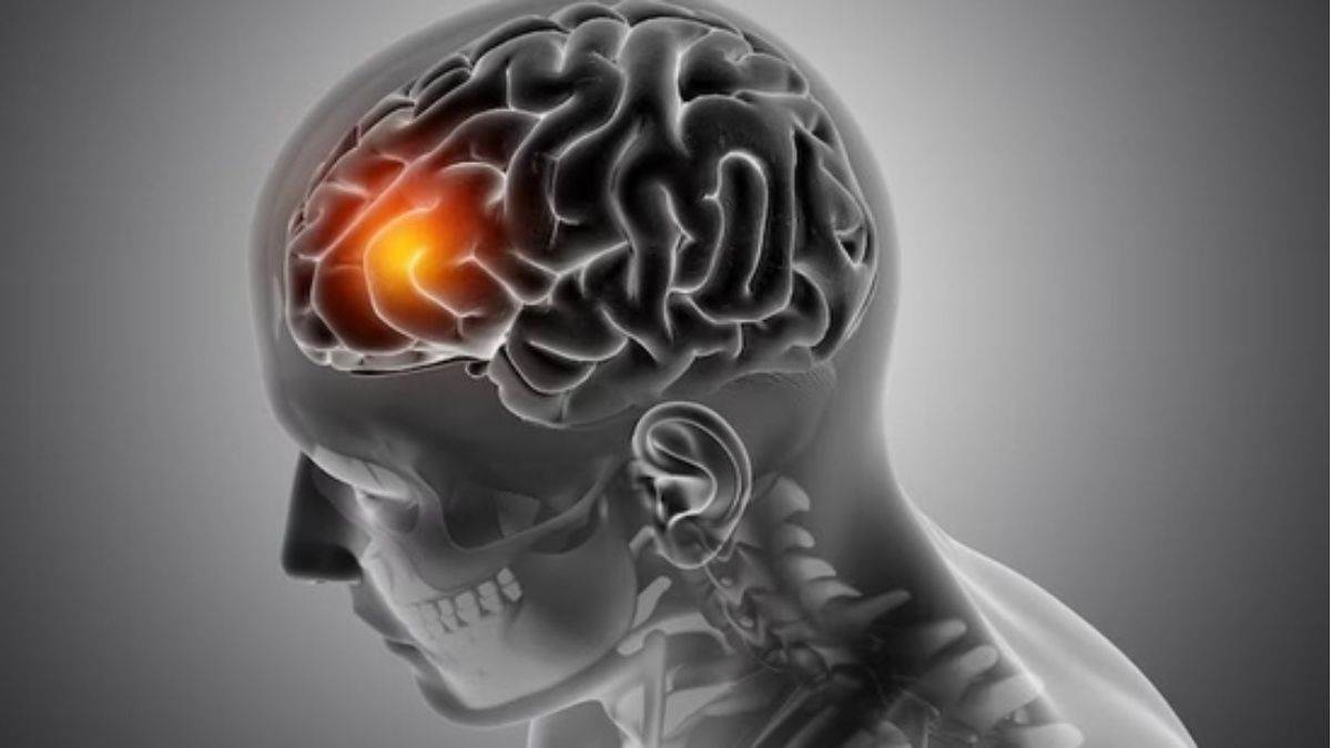 https://www.jagranimages.com/images/newimg/08062025/08_06_2025-brain_tumor__23958469_15594755.jpg