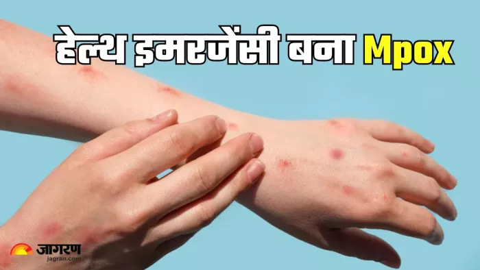 क्या है Mpox और इसके लक्षण (Picture Credit- Freepik)