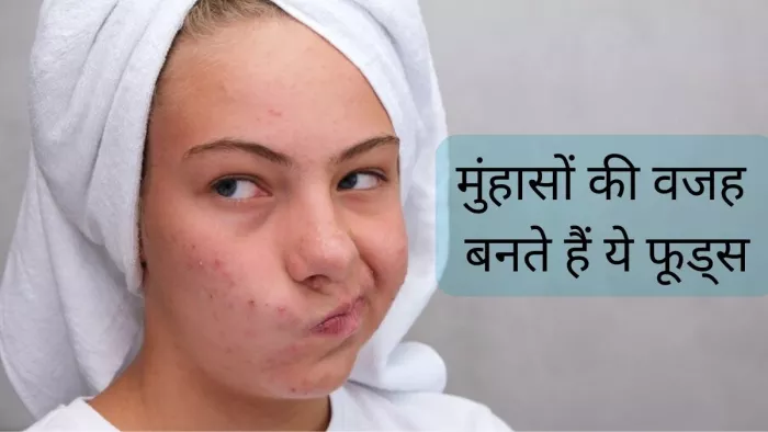 पिंपल्स की वजह बन सकते हैं ये फूड्स