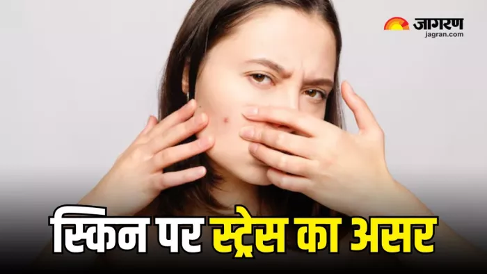 त्वचा पर कुछ ऐसे नजर आते हैं तनाव के संकेत (Picture Courtesy: Freepik)