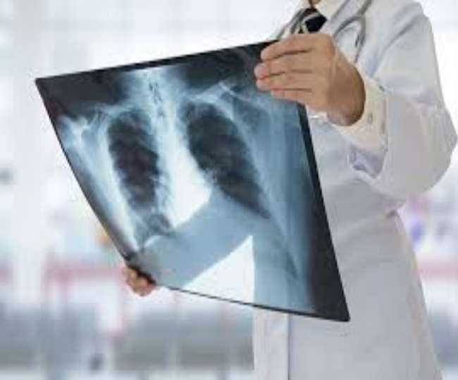 Coronavirus attack on TB patients two Tuberculosis infected people died in Panipat